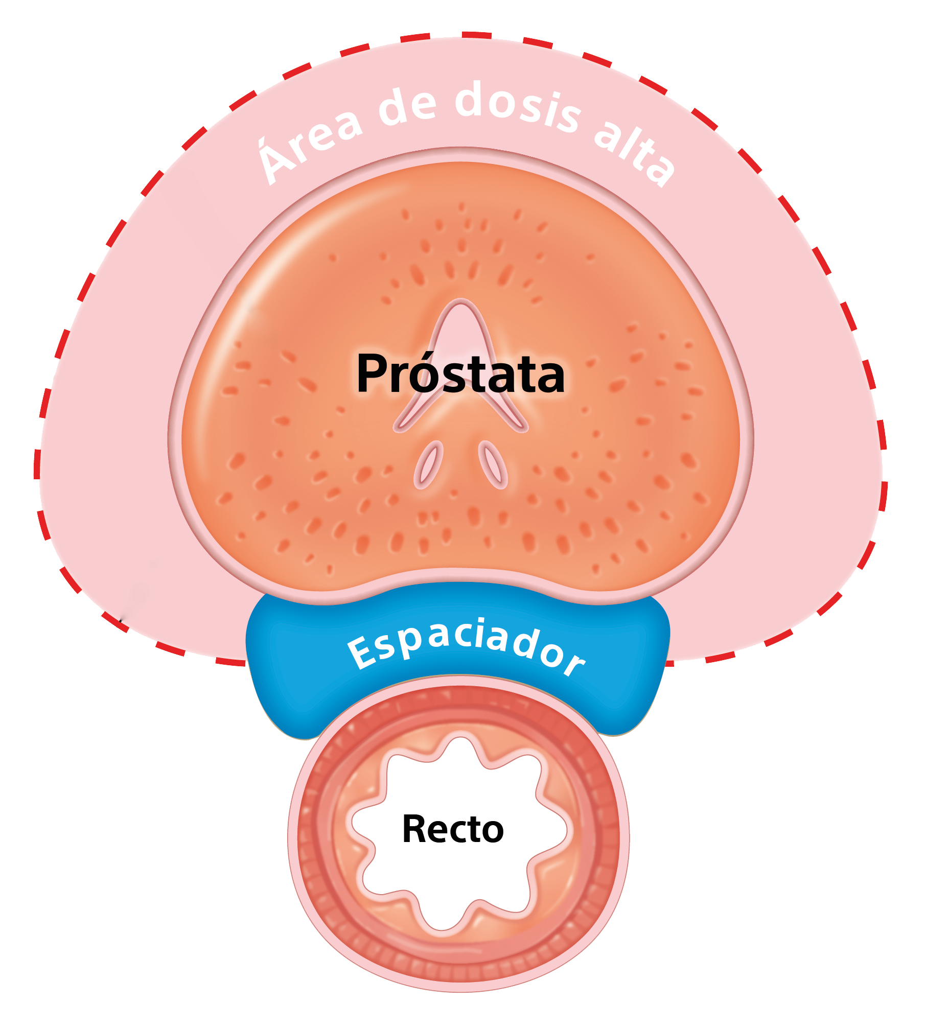 Con Hidrogel Espaciador