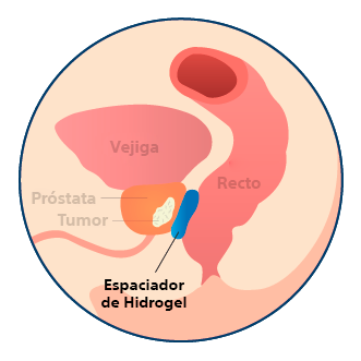 Anatomy with SpaceOAR Hydrogel