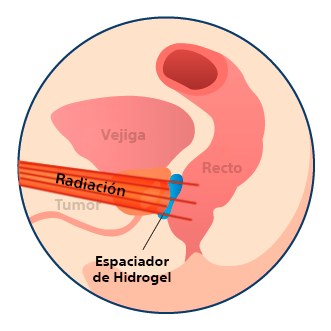 SpaceOAR Hydrogel with Radiation Therapy